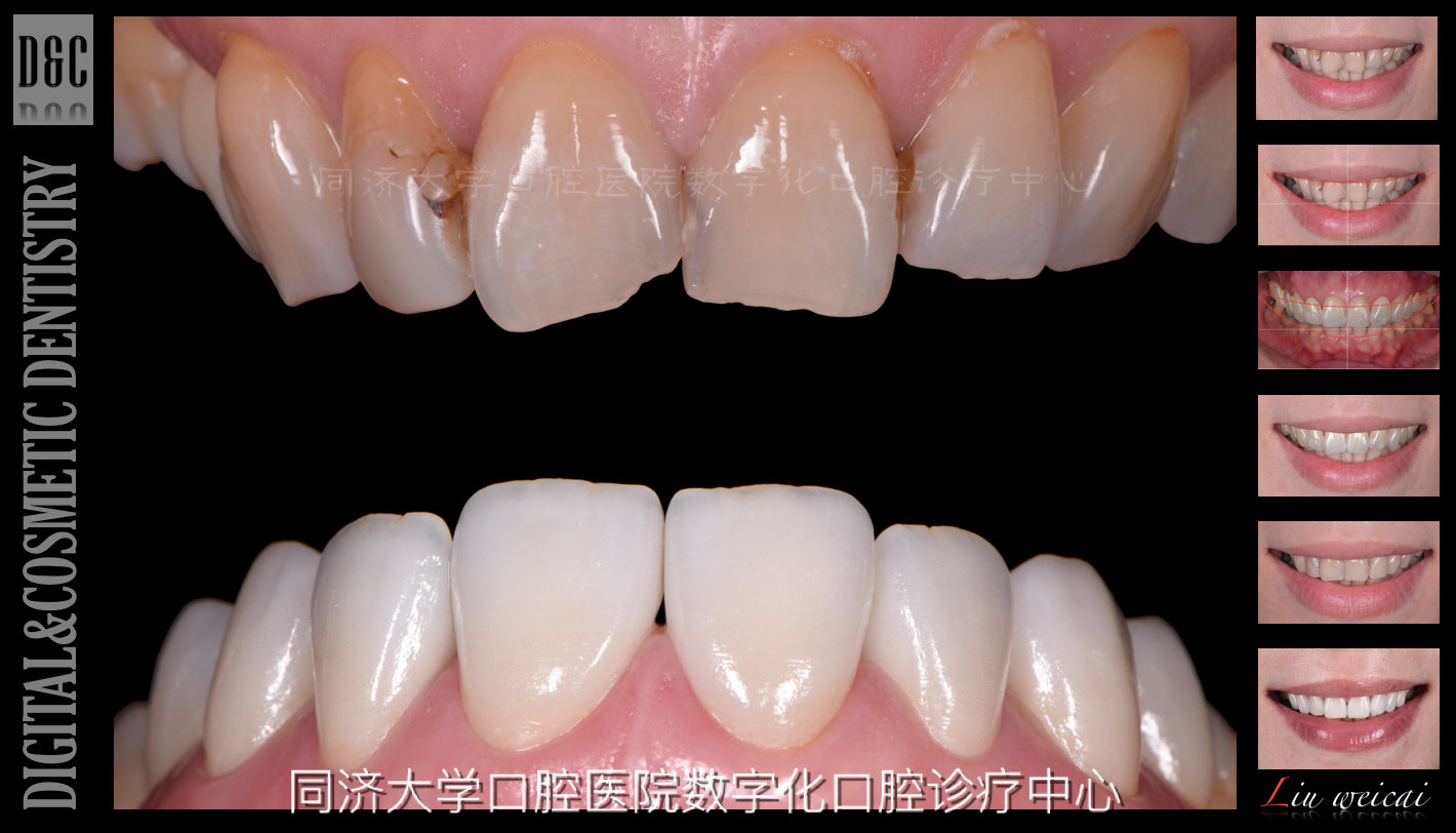 四環(huán)素牙貼面價(jià)格解析與比較指南